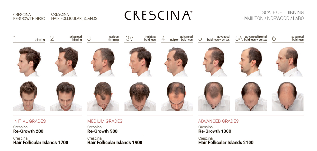 Шкала Гамильтона-Норвуда для классификации стадий облысения по мужскому типу.